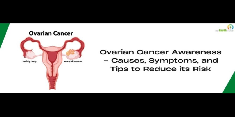 Ovarian Cancer Awareness Causes, Symptoms, and Tips to Reduce its Risk
